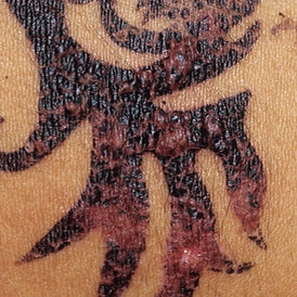 tattoo ink allergy reaction